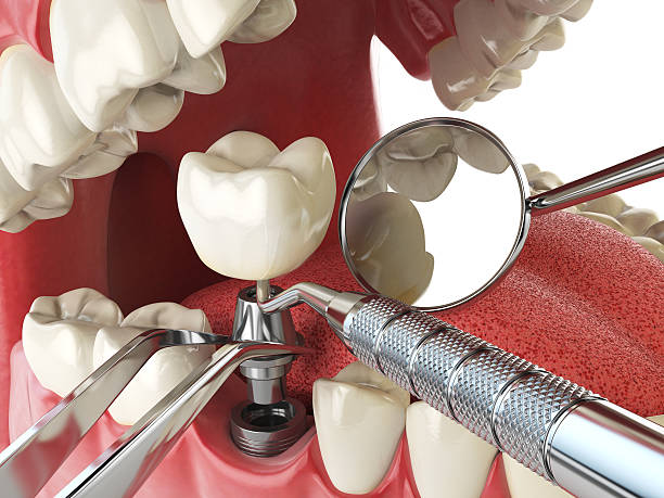 Best Emergency Treatment for Dental Infections or Abscesses in Tallapoosa, GA