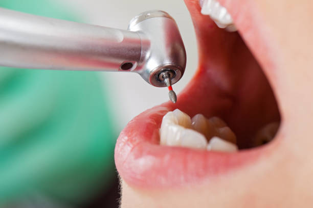 Best Emergency Wisdom Teeth Removal in Tallapoosa, GA